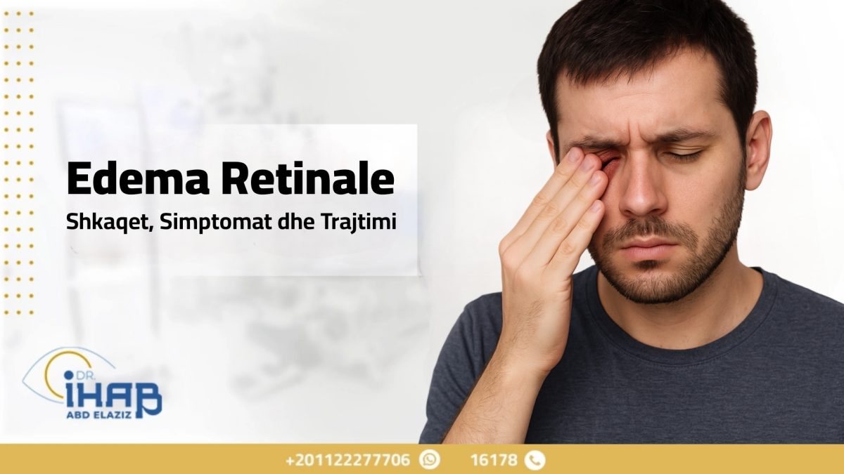 Shkaktarët e Edemës Retinale | Trajtimi dhe Parandalimi 1 Close-up e një syri me shenja të edema retinale dhe akumulim të lëngjeve