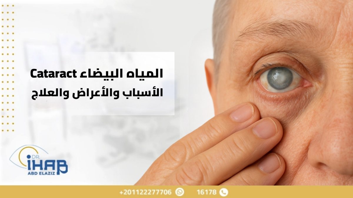 صورة توضيحية تعبر عن مرض المياه البيضاء (Cataract) في العين