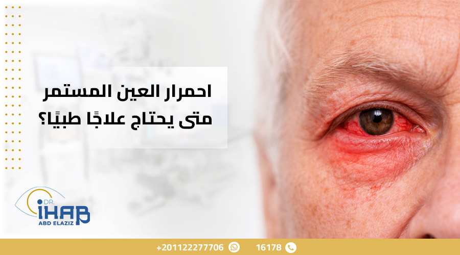 احمرار العين المستمر ومتى يحتاج علاجًا طبيًا